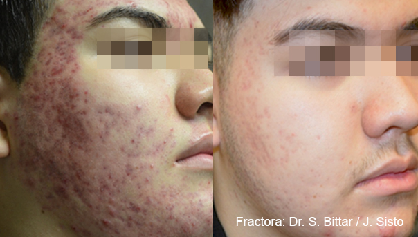 Fractora before and after