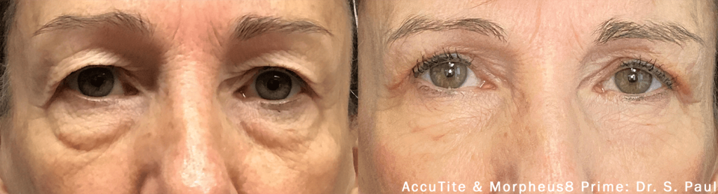 accutite-morpheus-prime-before-after-dr-s-paul-preview