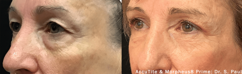 accutite-morpheus-prime-before-after-dr-s-paul-preview-2