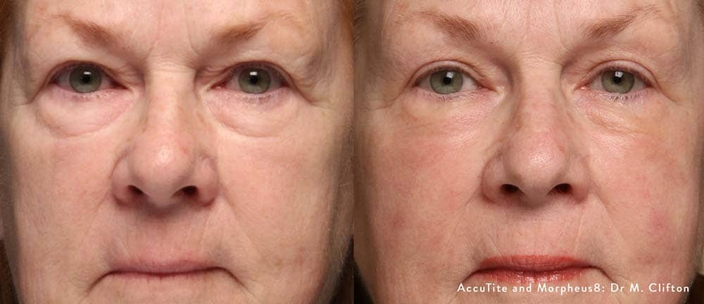 accutite-morpheus8-before-after-dr-m-clifton-preview
