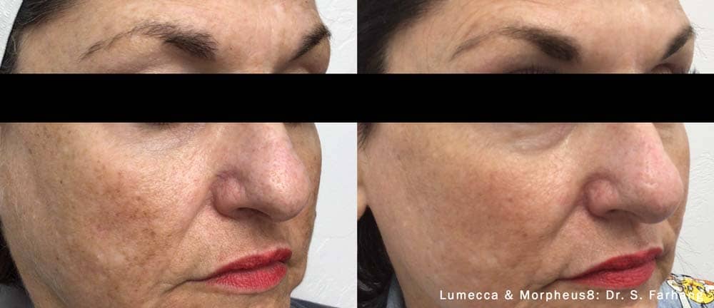 lumeccamorpheus8-before-after-dr-s-farhang-preview-1