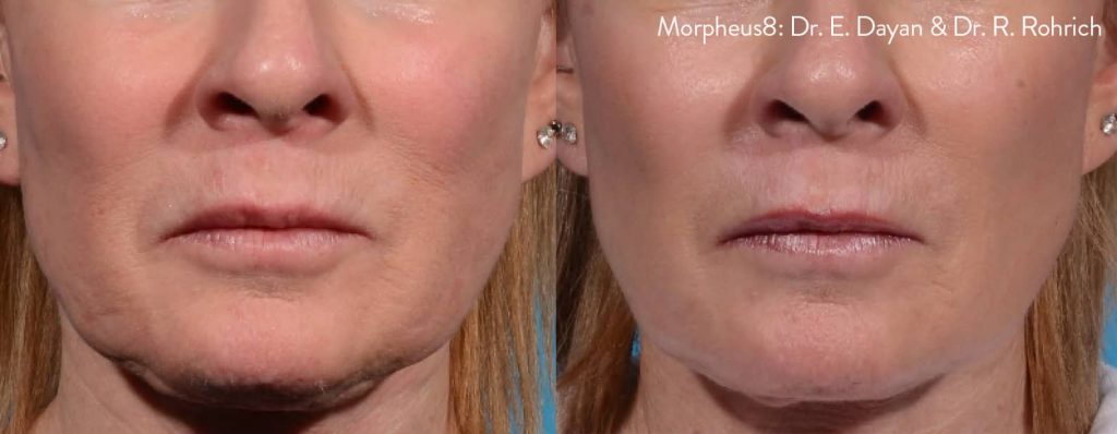 South-Surrey-Glow-Hormone-and-Aesthetics-morpheus8-before-after-dr-e-dayan-dr-r-rohrich-preview