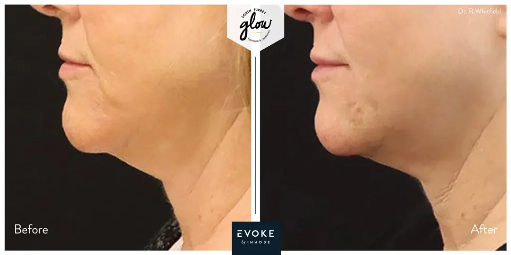 South-Surrey-Glow-Hormone and Aesthetics-Evoke-Before-After-05