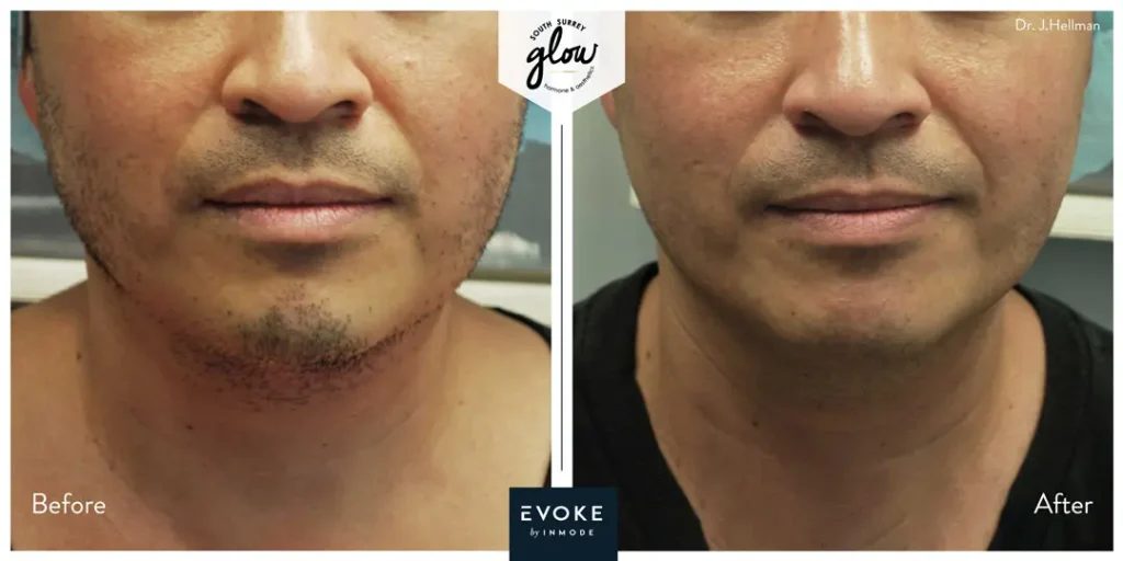 South-Surrey-Glow-Hormone and Aesthetics-Evoke-Before-After-06
