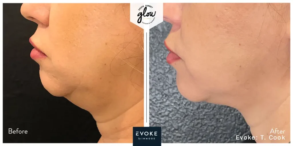South-Surrey-Glow-Hormone and Aesthetics-Evoke-Before-After-07