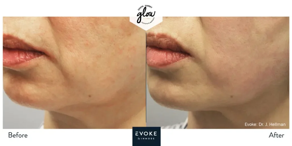 South-Surrey-Glow-Hormone and Aesthetics-Evoke-Before-After-08