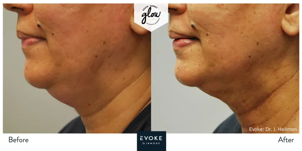 South-Surrey-Glow-Hormone and Aesthetics-Evoke-Before-After-09