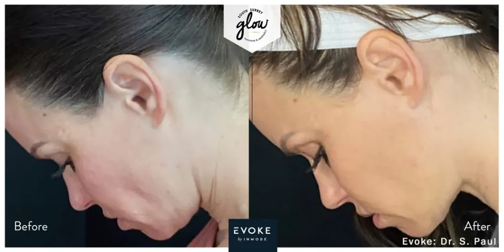South-Surrey-Glow-Hormone and Aesthetics-Evoke-Before-After-10