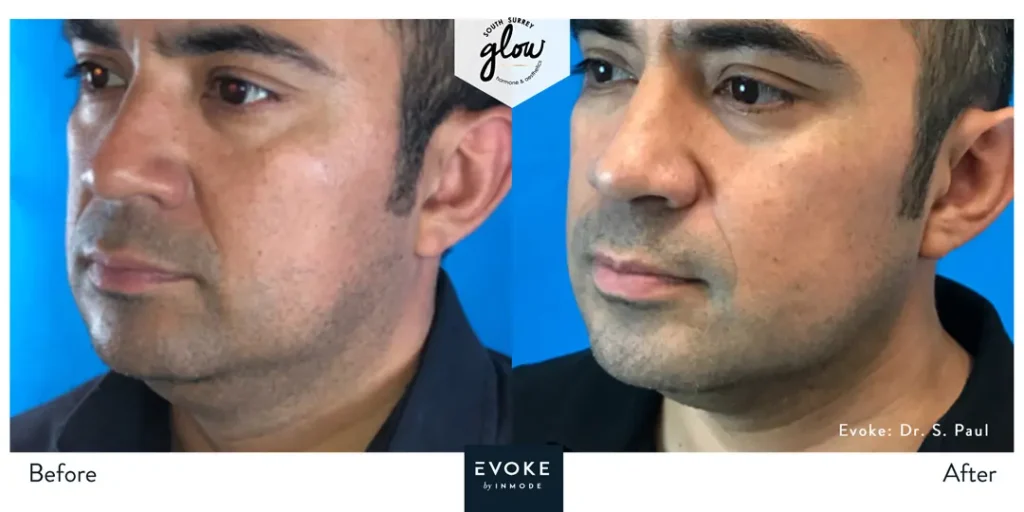 South-Surrey-Glow-Hormone and Aesthetics-Evoke-Before-After-11