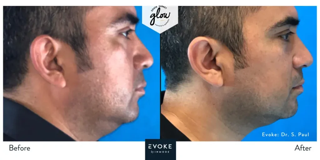 South-Surrey-Glow-Hormone and Aesthetics-Evoke-Before-After-12
