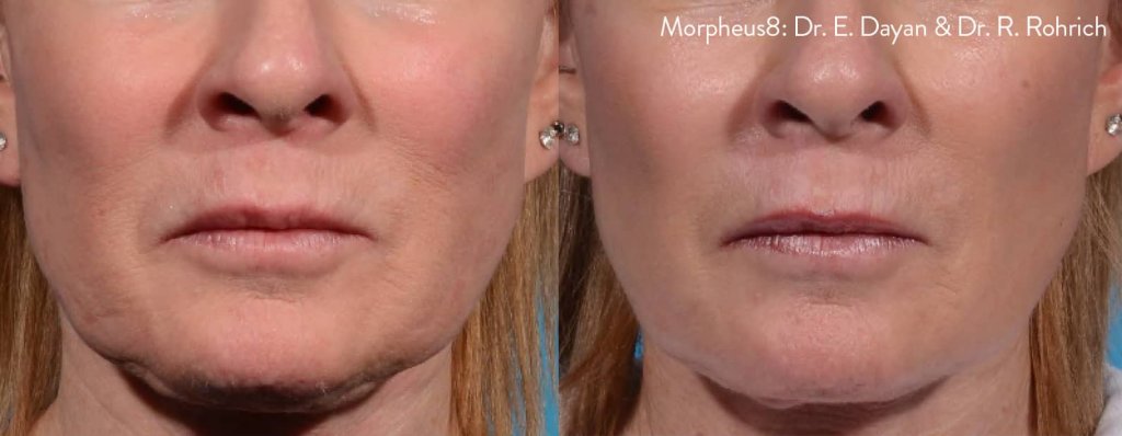morpheus8-before-after-dr-e-dayan-dr-r-rohrich-preview