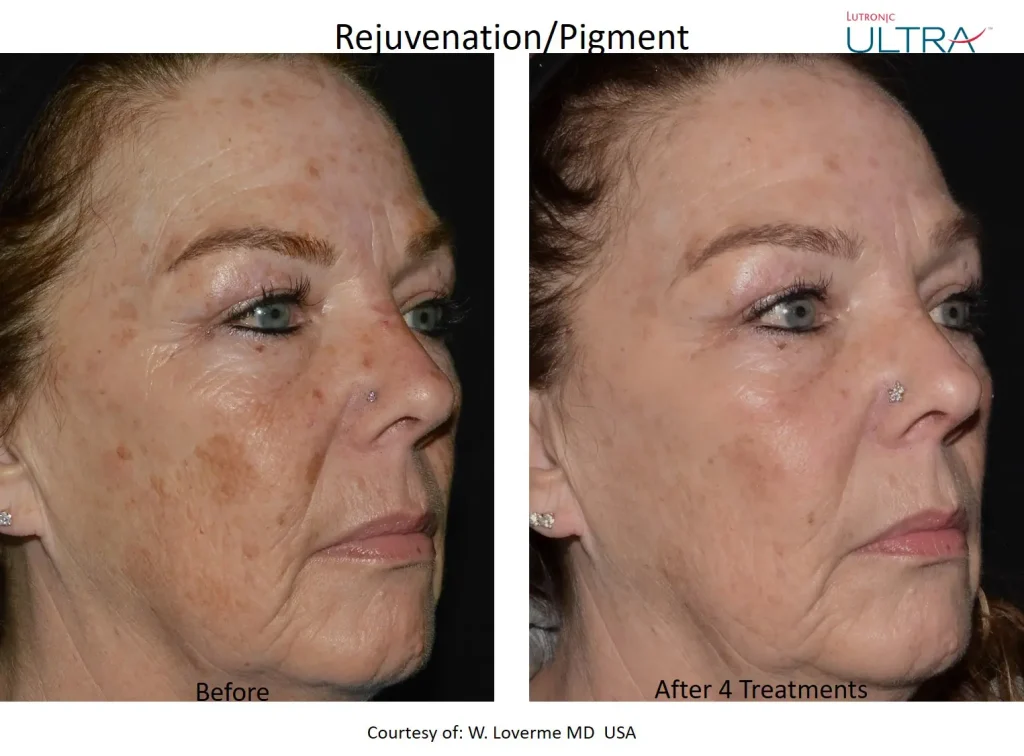 Ultra Loverme Rejuvenation Pigment 5 Right