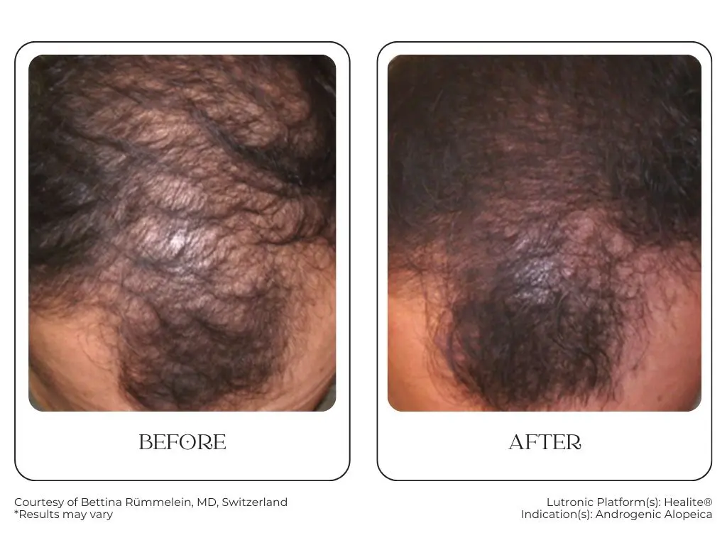South Surrey Glow - Cynosure Lutronic Healite II-Before and After -1