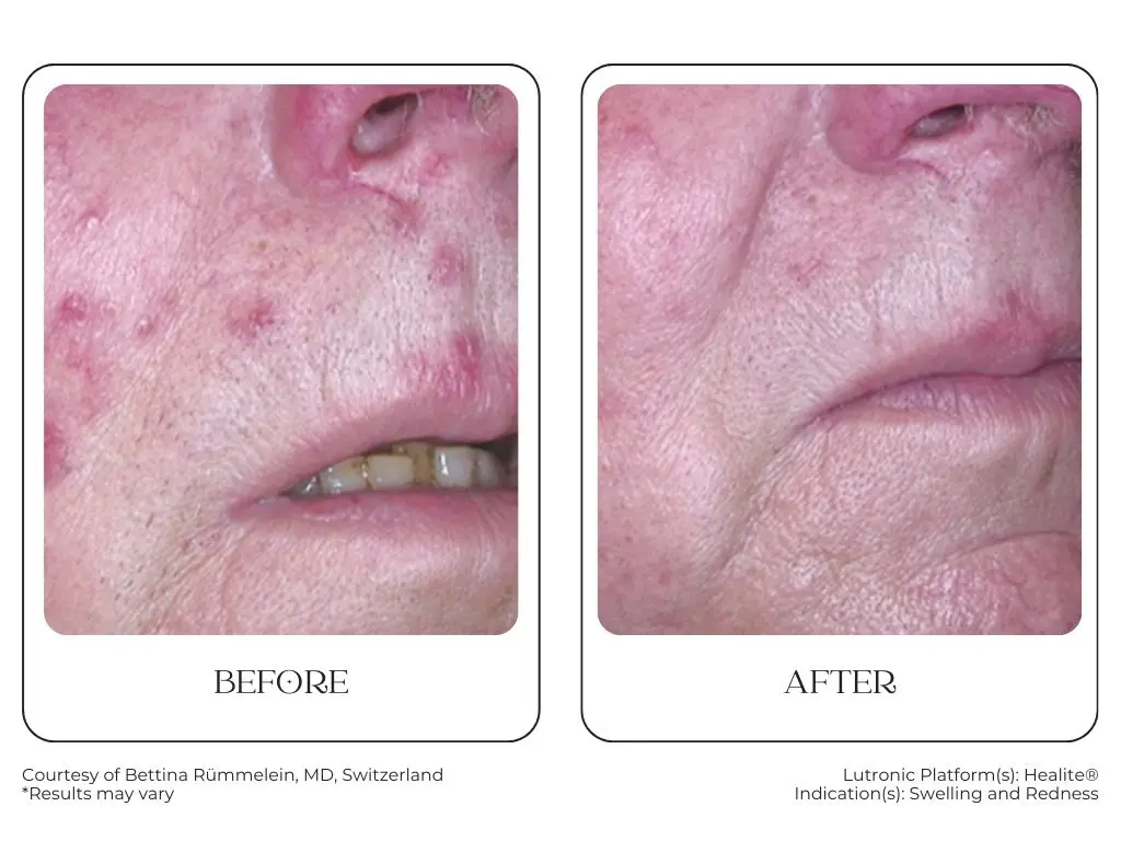 South Surrey Glow - Cynosure Lutronic Healite II-Before and After -2
