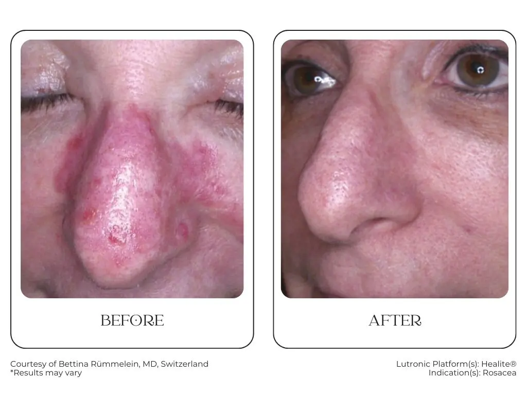 South Surrey Glow - Cynosure Lutronic Healite II-Before and After -3