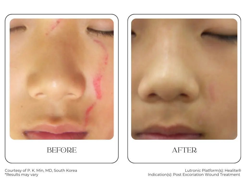South Surrey Glow - Cynosure Lutronic Healite II-Before and After -4