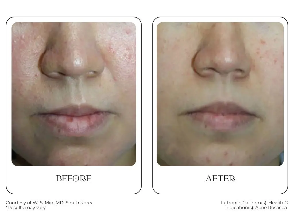 South Surrey Glow - Cynosure Lutronic Healite II-Before and After -5