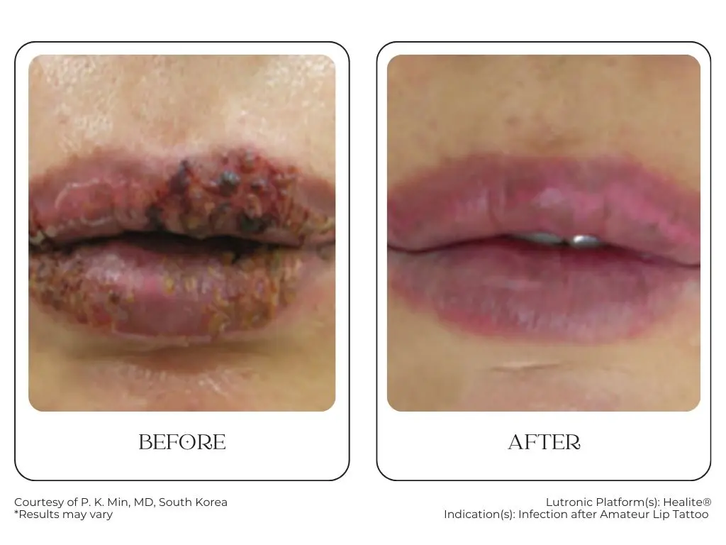 South Surrey Glow - Cynosure Lutronic Healite II-Before and After -6