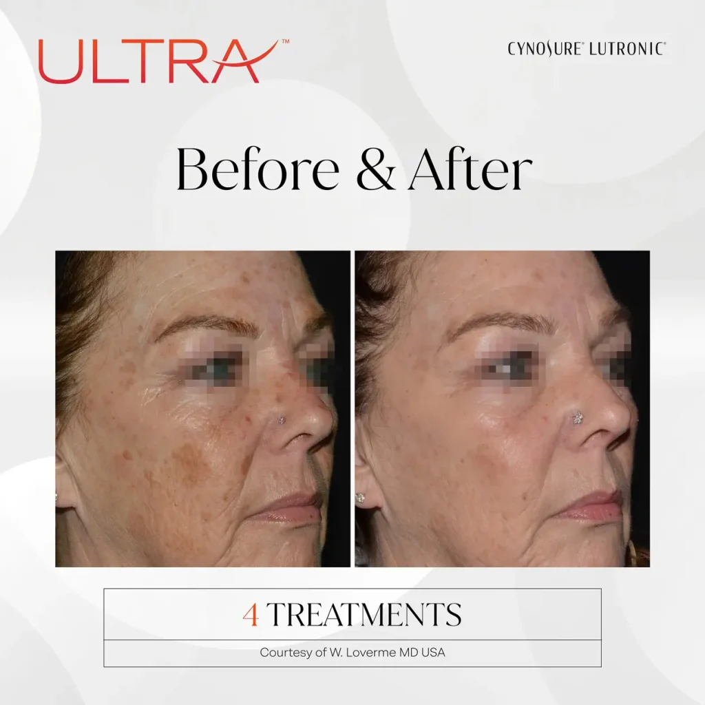 LaseMD Ultra before and after — 4 treatments, visibly brighter more uniform-looking complexion. Courtesy of Cynosure Lutronic, W. Loverme MD