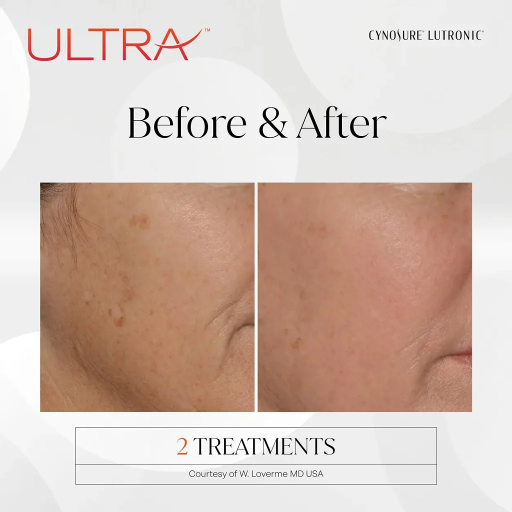 LaseMD Ultra before and after — 2 treatments, reduced look of sun spots and smoother texture. Courtesy of Cynosure Lutronic, W. Loverme MD