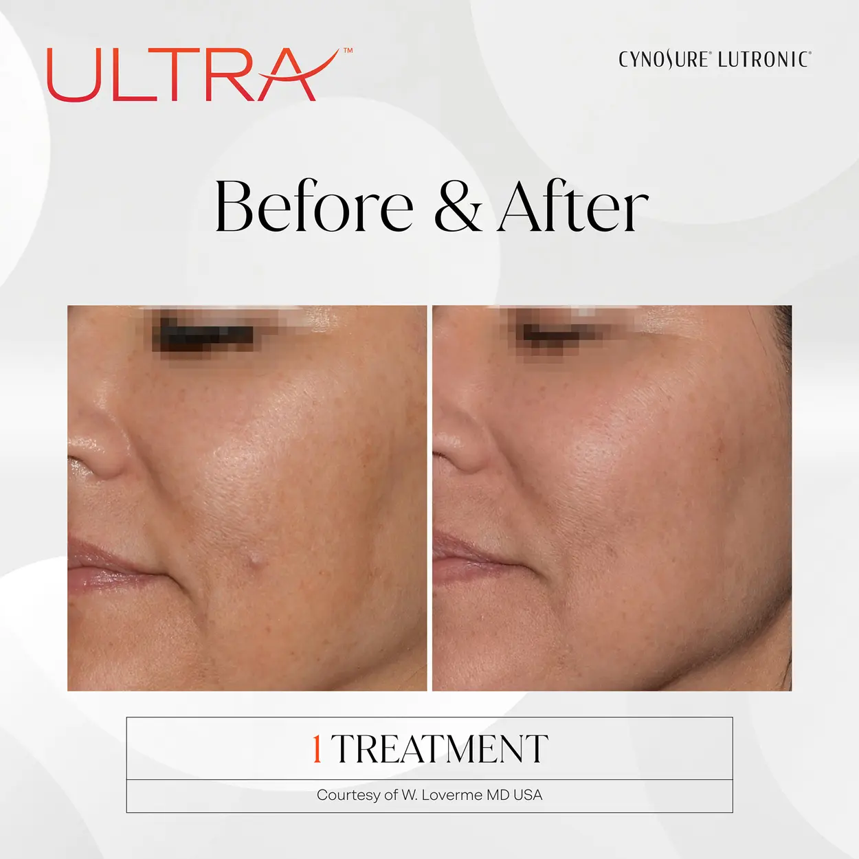 LaseMD Ultra before and after enlarged view