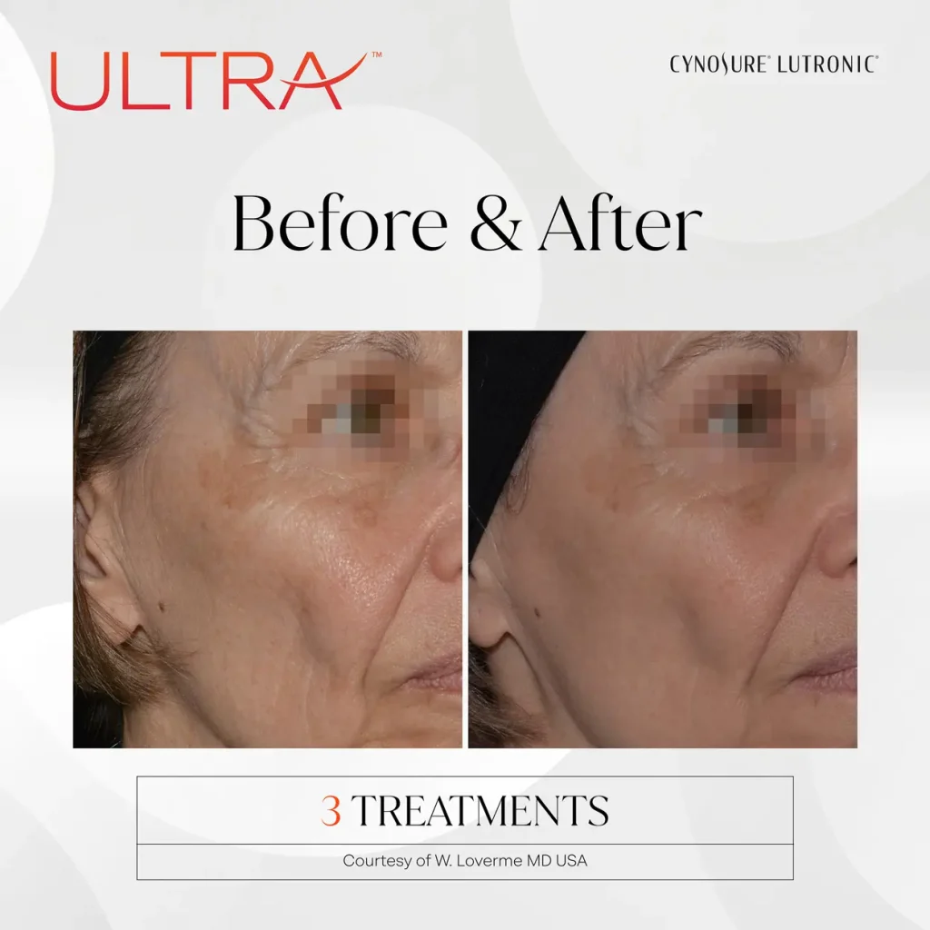 LaseMD Ultra before and after — 3 treatments, softer look of fine lines and pigment. Courtesy of Cynosure Lutronic, W. Loverme MD